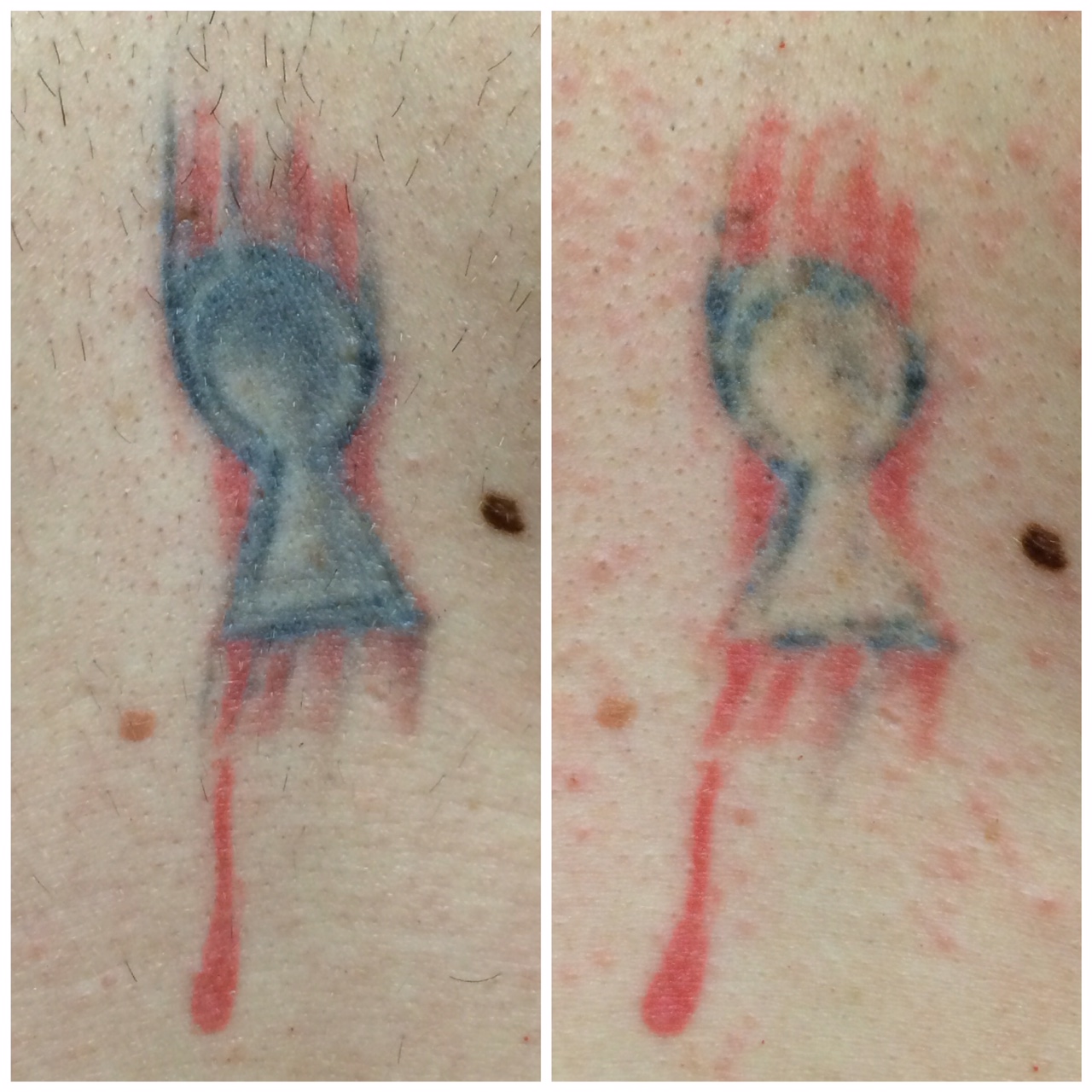 PicoSure Tattoo 1 Treatment - DK